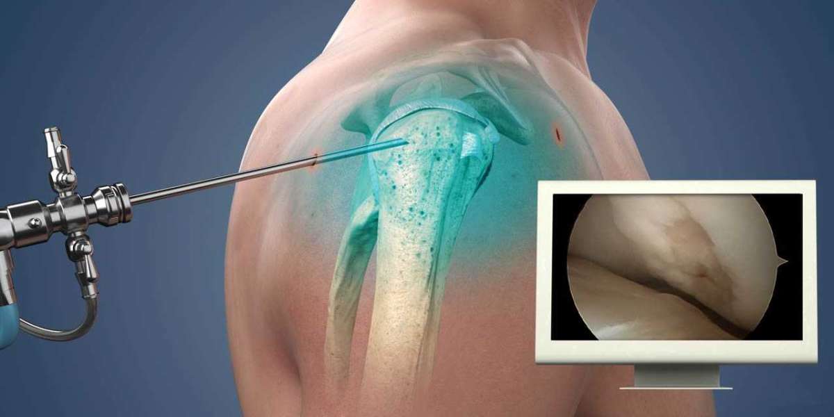 Experts in Shoulder Arthroscopy in Delhi: Restoring Health