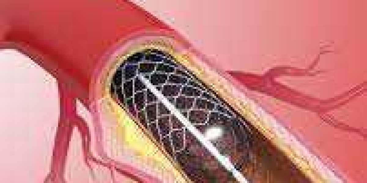 Coronary Angioplasty in Jaipur: A Lifeline for Heart Health