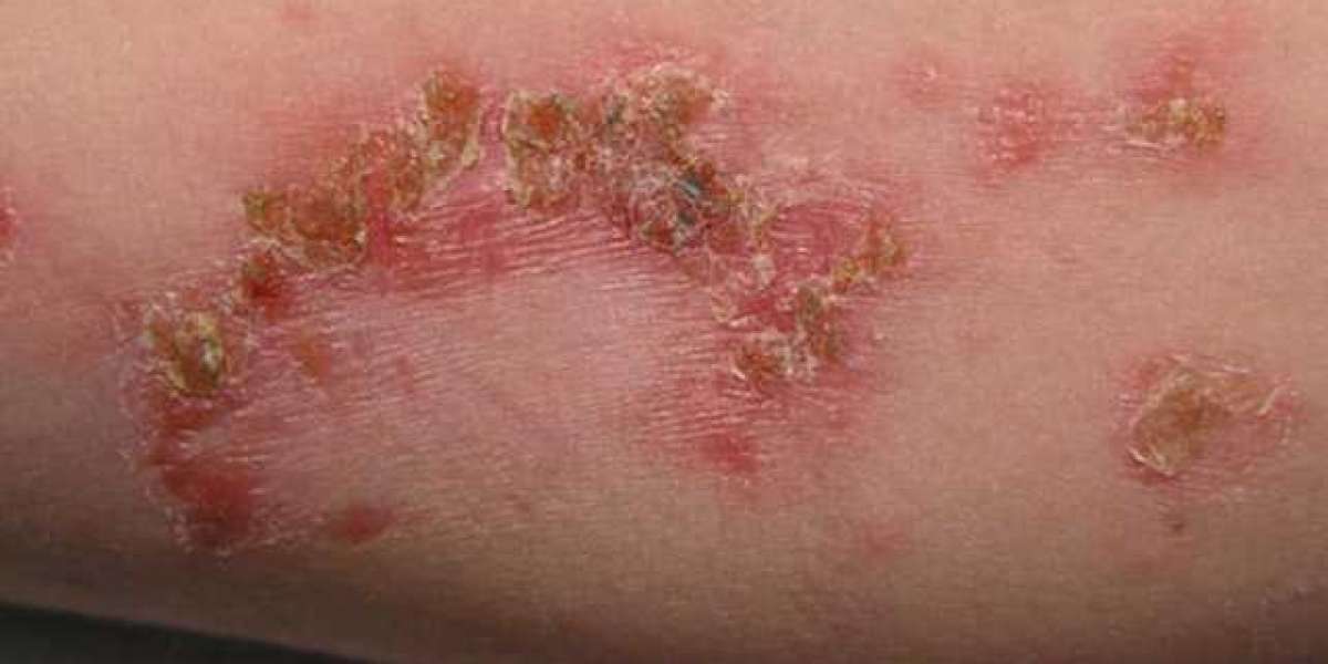 Bacterial infections: Causes, Symptoms and Treatments